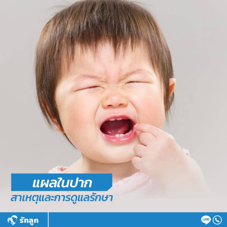 แผลในปาก สาเหตุและการดูแลรักษา