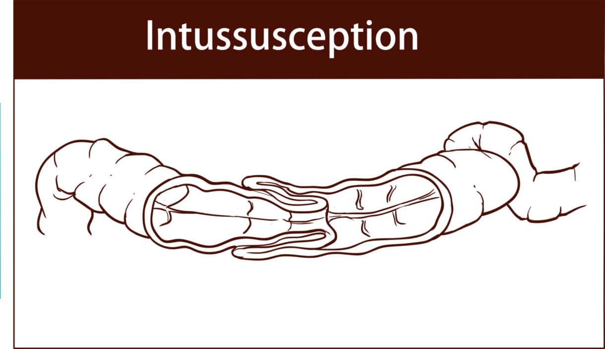 Intussusception