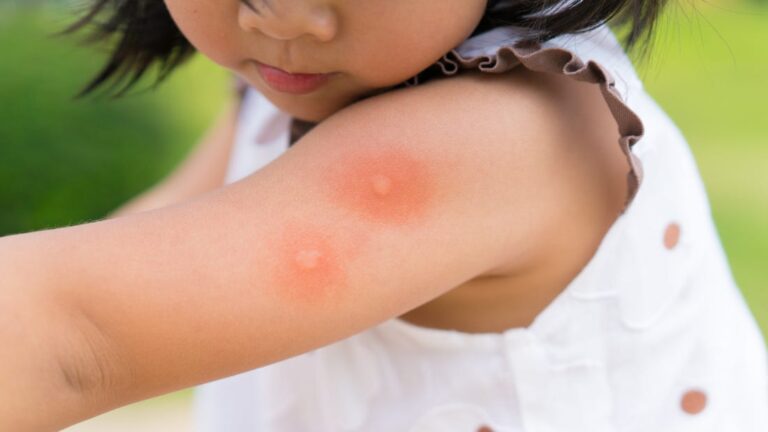 Mosquitoes bite children at risk of dangerous diseases